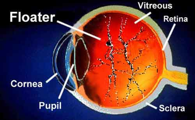 Vielleicht kennen Sie das Gefühl von einem Vlek in Oog?